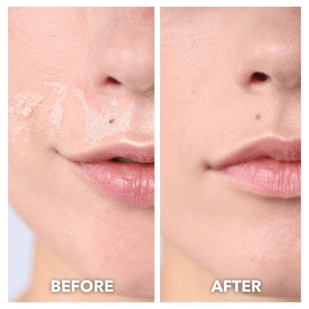 DERMALEA LUXE™ Pro Max LED Therapy Mask System Special Offer