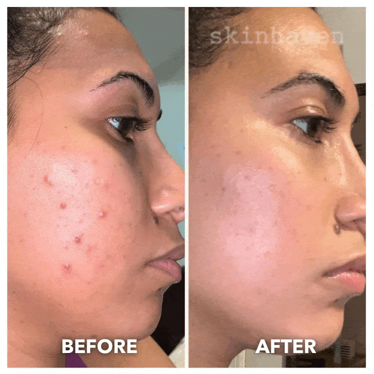 DERMALEA LUXE™ Pro Max LED Therapy Neck Add-On