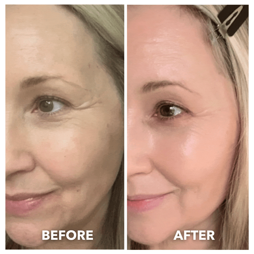 DERMALEA LUXE™ Pro Max LED Therapy Mask System Special Offer