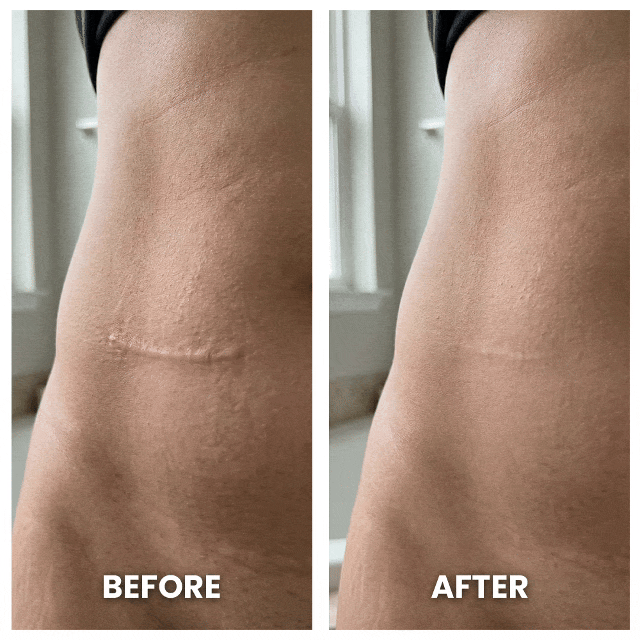 Dermalea DermaShield™ Pro Scar Matrix